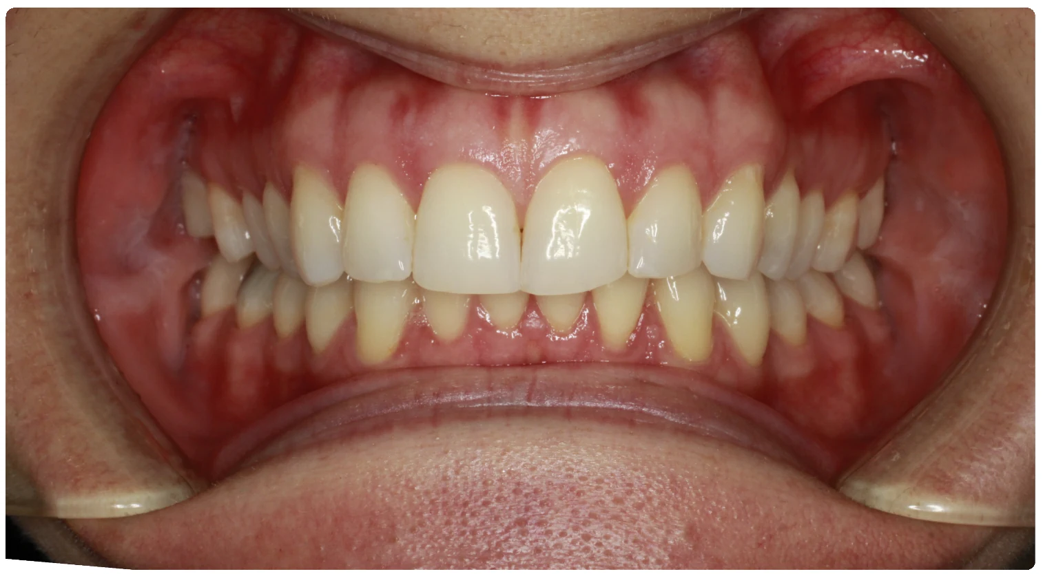 Before treatment smile close-up 1