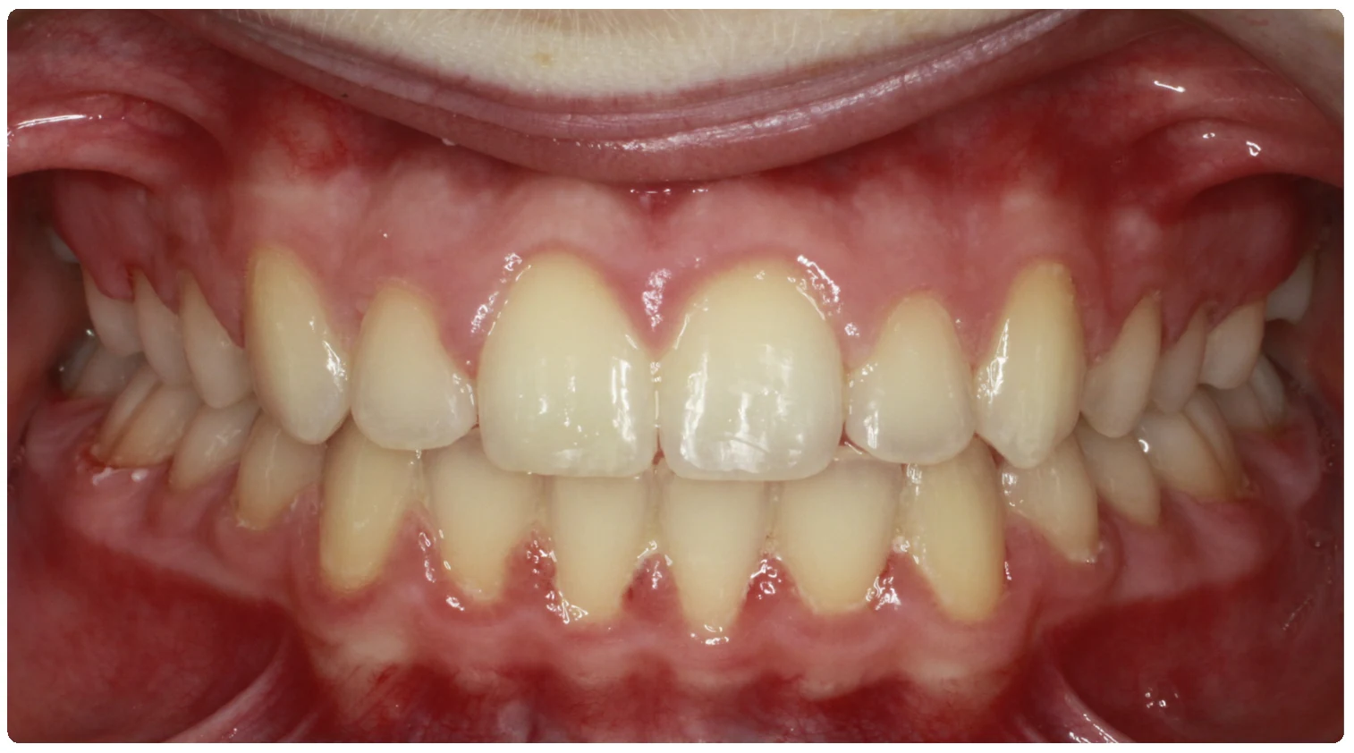 After treatment smile close-up 2