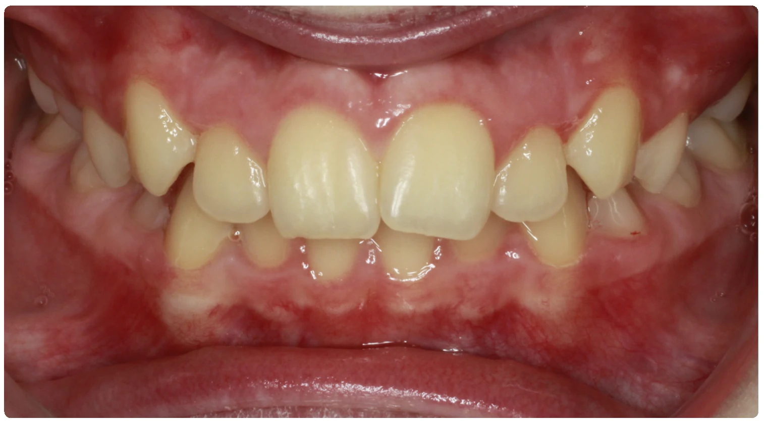 Before treatment smile close-up 2