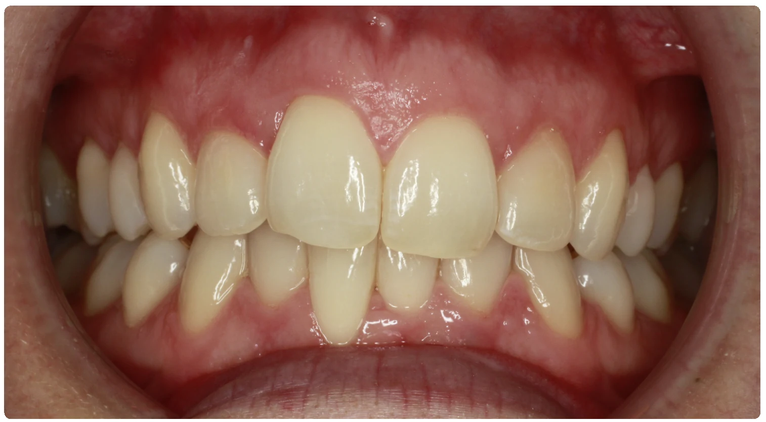 Before treatment smile close-up 3