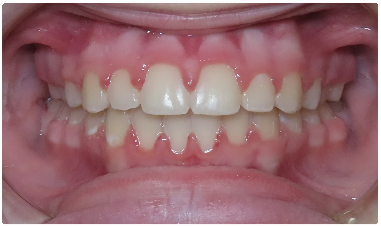 After treatment smile close-up 4