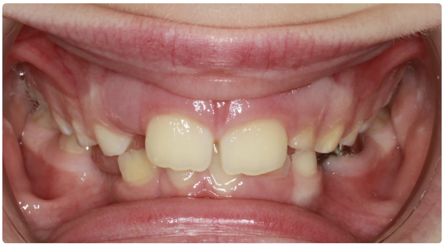 Before treatment smile close-up 4