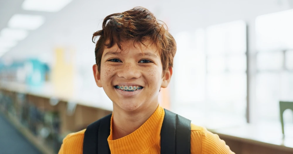 Clear braces