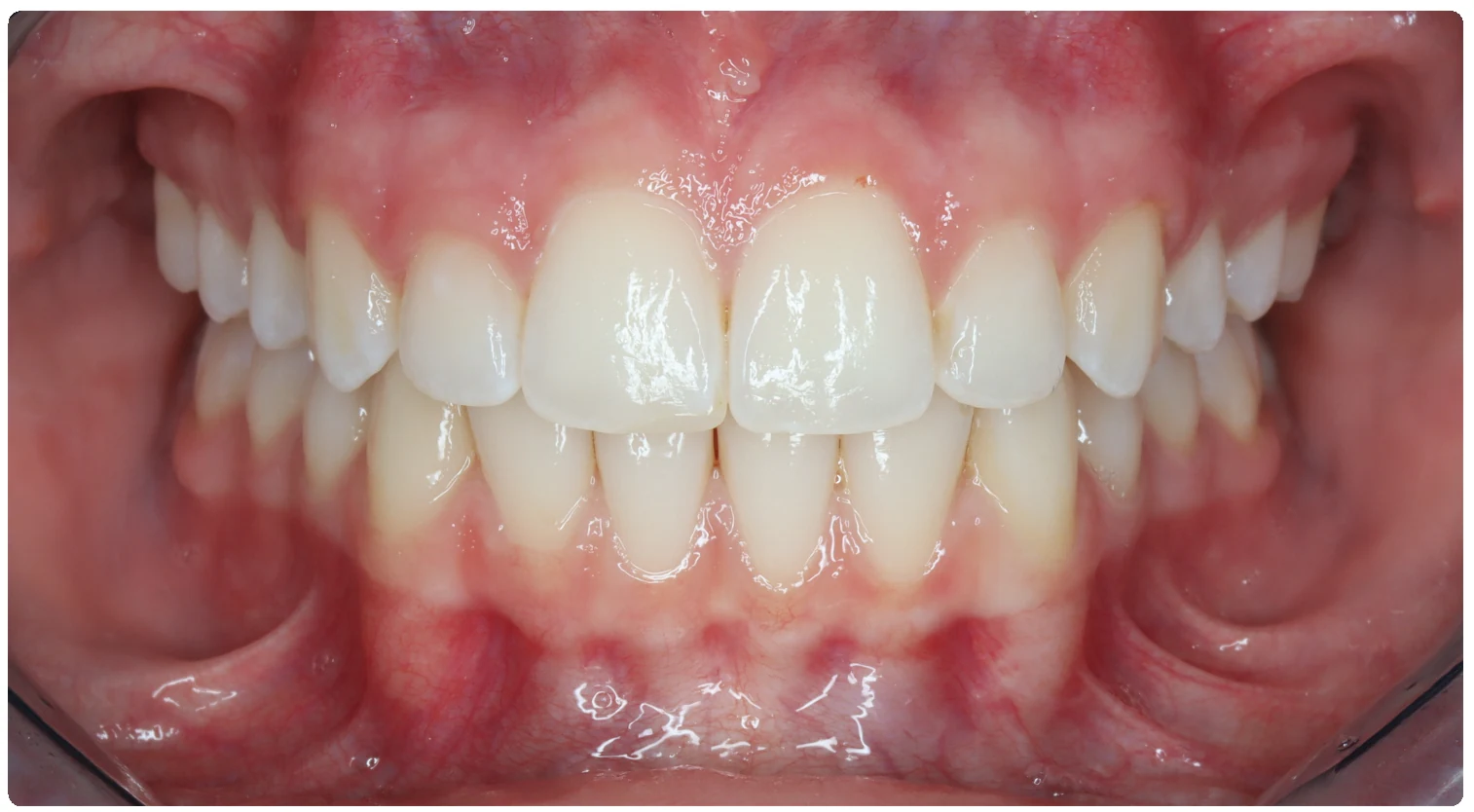 After treatment smile close-up 5